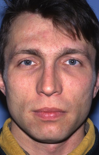 Revision Rhinoplasty after 981036