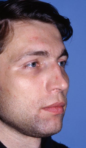 Revision Rhinoplasty 981036