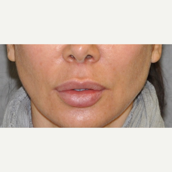 35-44 year old woman treated with Lip Lift before 3175558