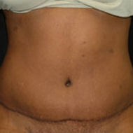 35-44 year old woman treated with Tummy Tuck after 2285545