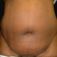 35-44 year old woman treated with Tummy Tuck before 2285545