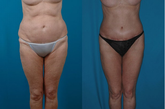 66-year-old woman treated with a Thigh Lift. before 574590