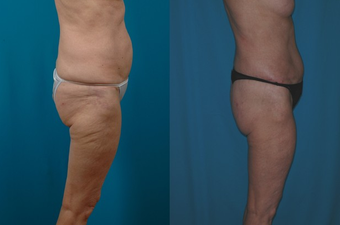 66-year-old woman treated with a Thigh Lift. after 574590