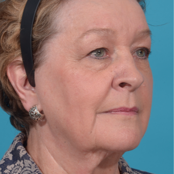72 year old woman treated with Facelift/necklift, upper eyelid blepharoplasty before 3260370
