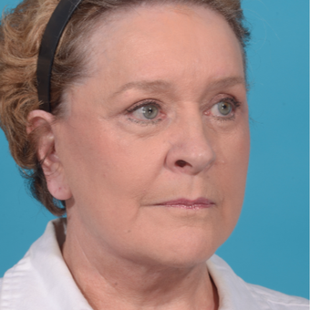 72 year old woman treated with Facelift/necklift, upper eyelid blepharoplasty after 3260370
