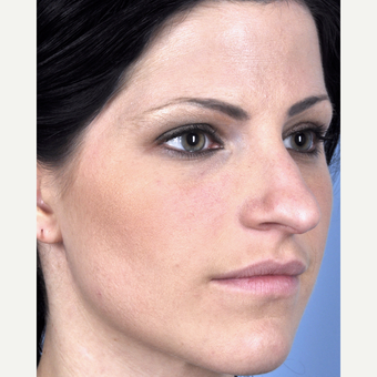 25-34 year old woman treated with Rhinoplasty before 3815693