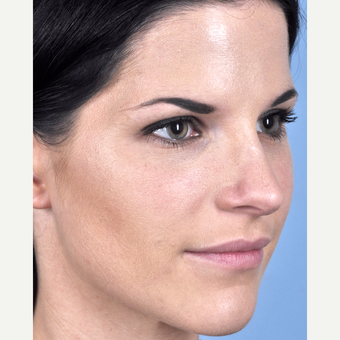 25-34 year old woman treated with Rhinoplasty after 3815693