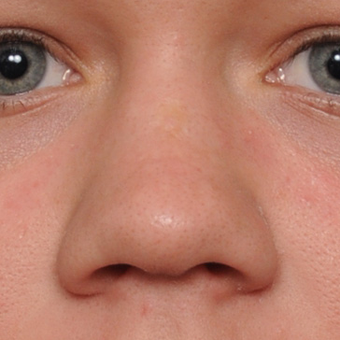 18-24 year old woman treated with Rhinoplasty before 3267145