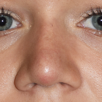 18-24 year old woman treated with Rhinoplasty after 3267145