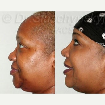 55-64 year old woman treated with Rhinoplasty before 2296932