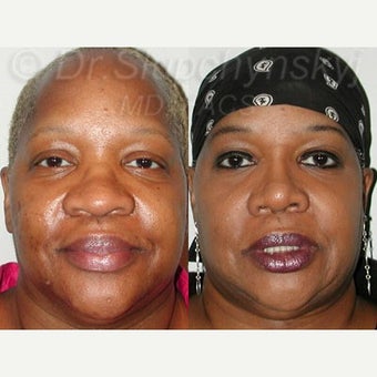 55-64 year old woman treated with Rhinoplasty after 2296932