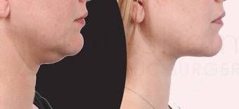 38 year old woman jawline and neck liposuction before 1127762