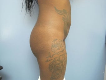 25-34 year old woman treated with Butt Implants and Liposuction of the Back 2831562