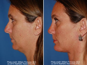 Neck Liposuction before 1389723