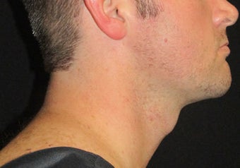 33 year old man treated with NeckTite RFAL after 3683625