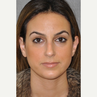 25-34 year old woman treated with Rhinoplasty before 3181417