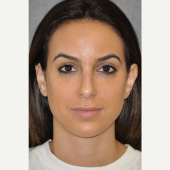 25-34 year old woman treated with Rhinoplasty after 3181417
