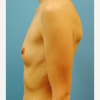 25-34 year old woman treated with Breast Augmentation before 3061123