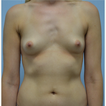 26 year old woman treated with Breast Fat Transfer before 3432190