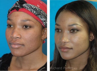 30 year old African American Rhinoplasty Madison WI after 1097470