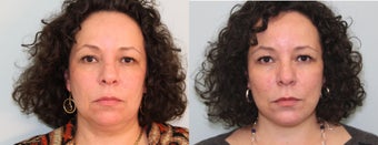 Facelift before 559534