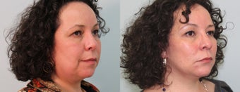 Facelift after 559534
