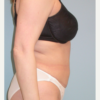 35-44 year old woman treated with Tummy Tuck after 3061412