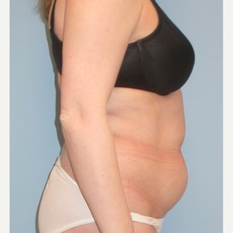35-44 year old woman treated with Tummy Tuck before 3061412