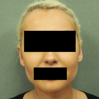 18-24 year old woman treated with Ear Surgery after 3649495