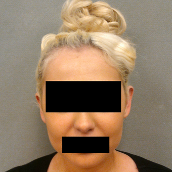 18-24 year old woman treated with Ear Surgery before 3649495