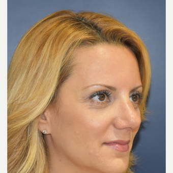 35-44 year old woman treated with Nose Surgery after 3131236