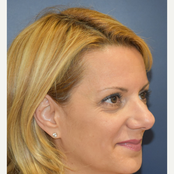 35-44 year old woman treated with Nose Surgery before 3131236