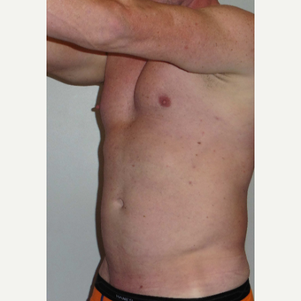 35-44 year old man treated with Vaser Liposuction before 3382565