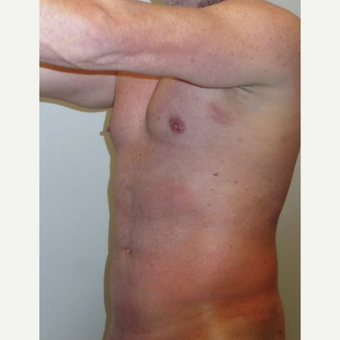 35-44 year old man treated with Vaser Liposuction after 3382565