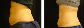 CoolSculpting before 1051547