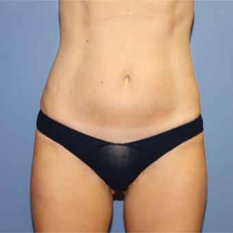 45-54 year old woman treated with Mini Tummy Tuck after 2853454