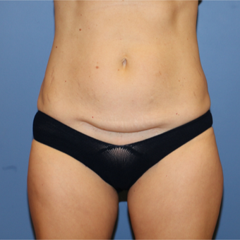 45-54 year old woman treated with Mini Tummy Tuck before 2853454