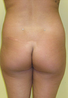 Buttock Enhancement 459490