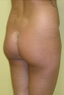 Buttock Enhancement before 459490