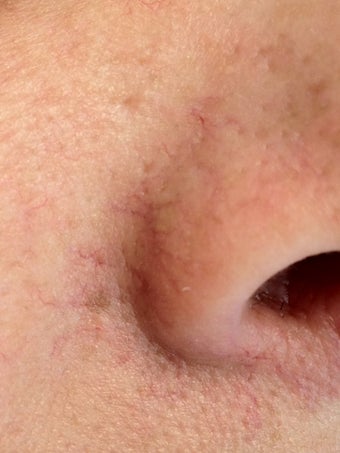 Laser Vein Removal before 695141