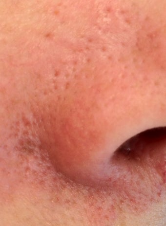 Laser Vein Removal after 695141