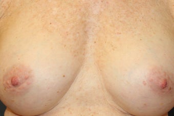 Nipple reduction after 1480271
