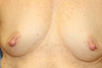 Nipple reduction before 1480271