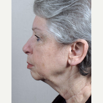 65-74 year old woman treated with Mini-Facelift before 3212980