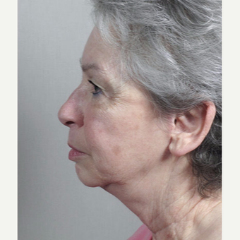 65-74 year old woman treated with Mini-Facelift after 3212980