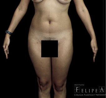 18-24 year old woman treated with Abdominal Etching before 3413337