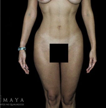18-24 year old woman treated with Abdominal Etching after 3413337