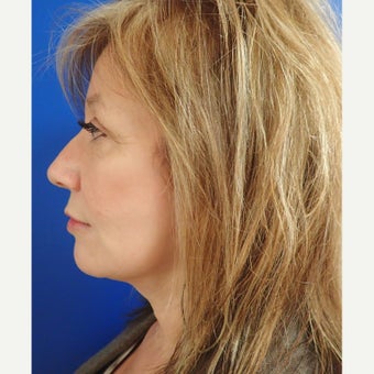 45-54 year old woman treated with Facelift after 2618422