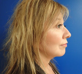 45-54 year old woman treated with Facelift 2618422