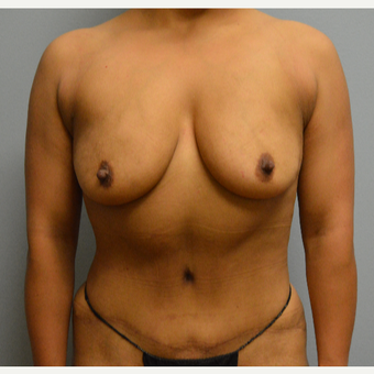 25-34 year old woman treated with Breast Lift with Implants before 3629391